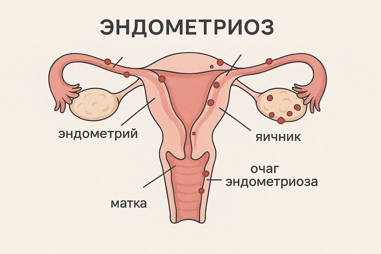 Что такое эндометриоз Что такое эндометриоз