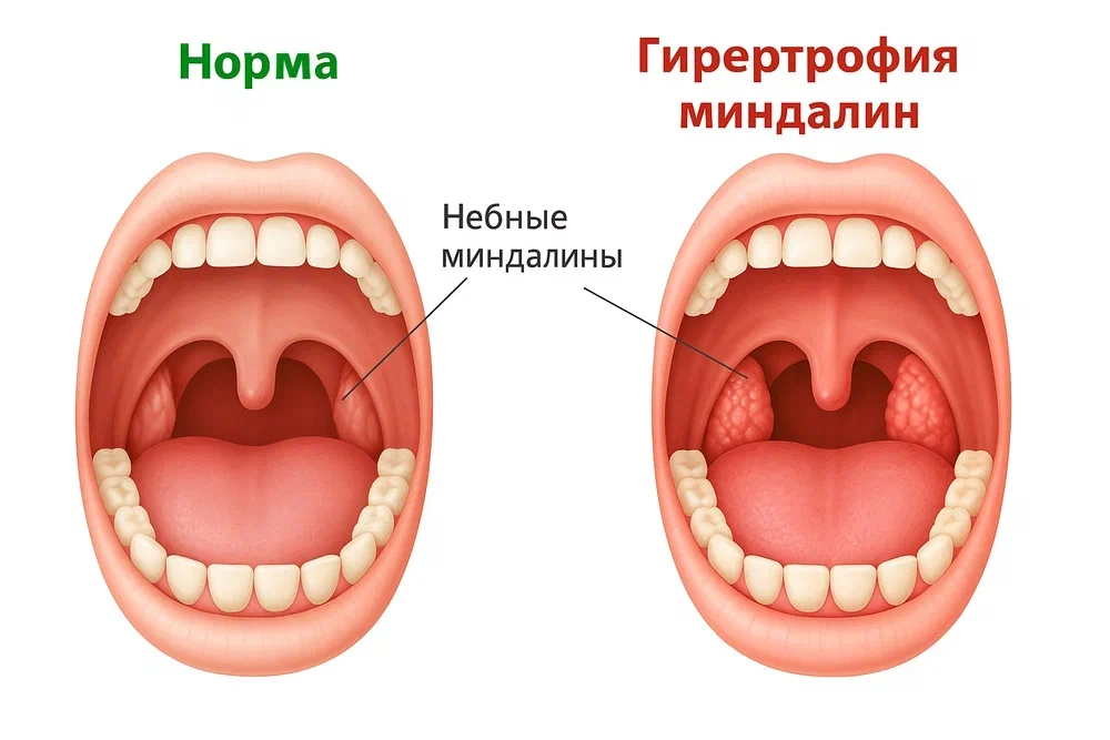 Гипертрофия небных миндалин Гипертрофия небных миндалин