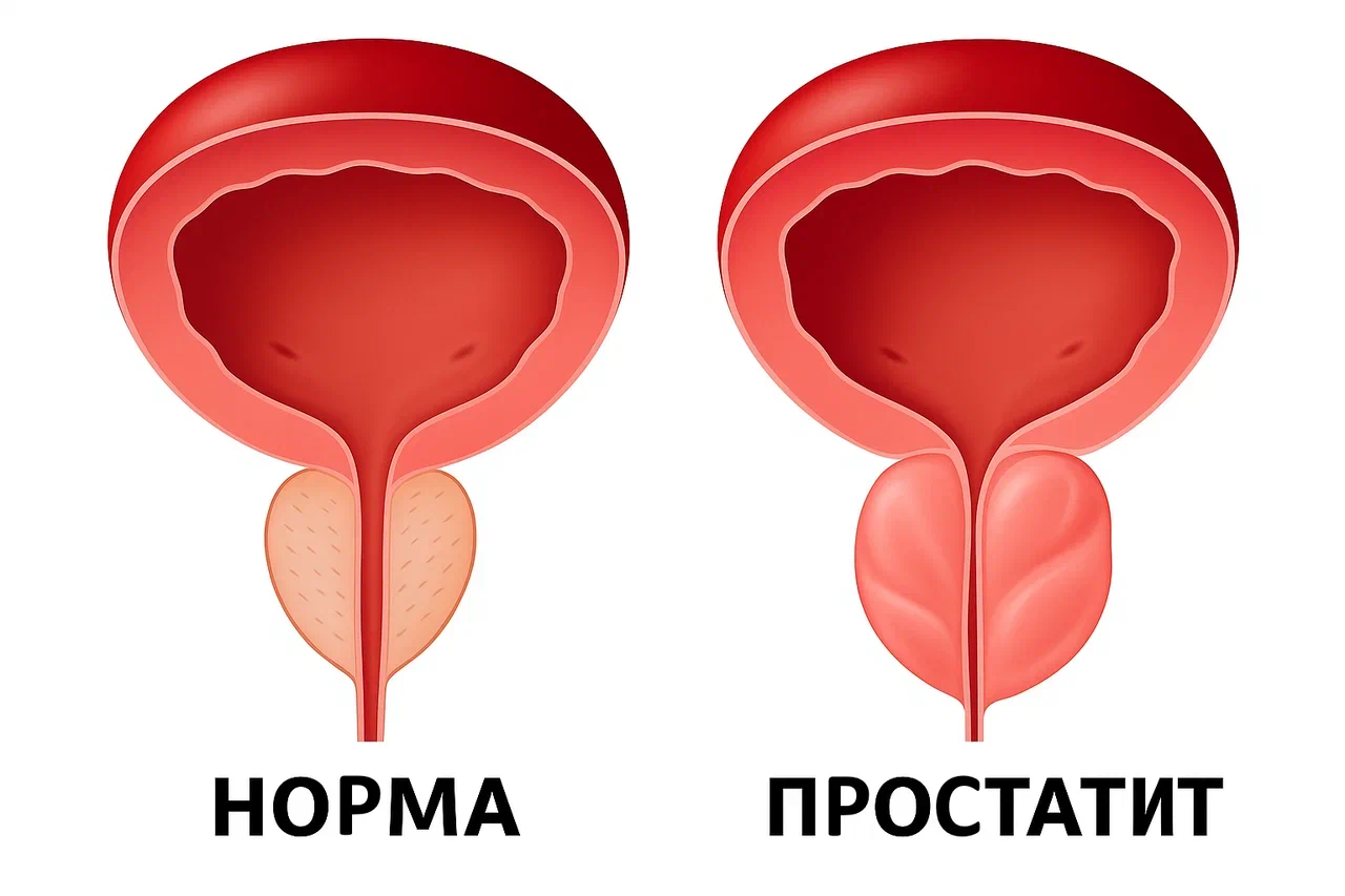 Лечение простатита Лечение простатита