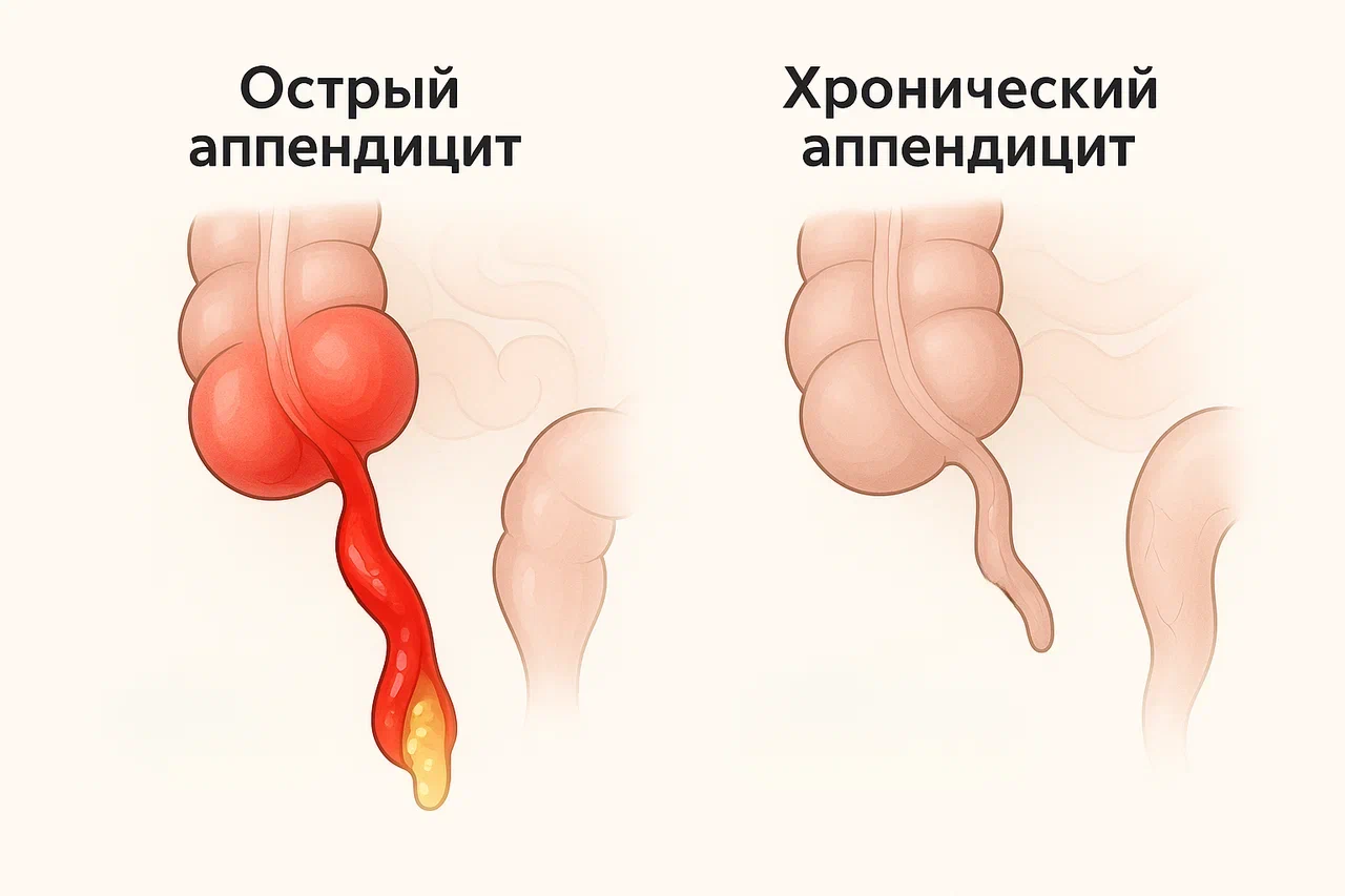 Виды аппендицита Виды аппендицита
