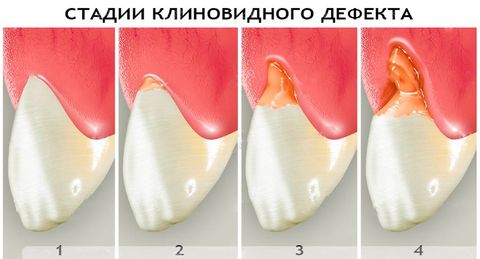 Что такое клиновидные дефекты зубов. Смотреть фото Что такое клиновидные дефекты зубов. Смотреть картинку Что такое клиновидные дефекты зубов. Картинка про Что такое клиновидные дефекты зубов. Фото Что такое клиновидные дефекты зубов