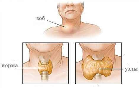 Заболевания щитовидной железы - симптомы и лечение