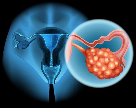 Какие могут бы болезни яичников у женщин thumbnail