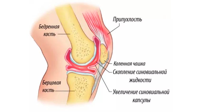 Пункция коленного сустава