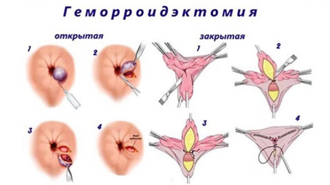 Геморроидэктомия