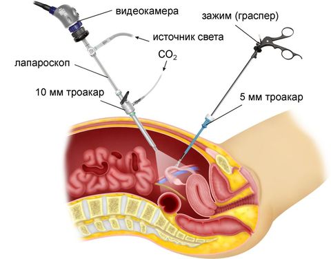 laparoskopiya1