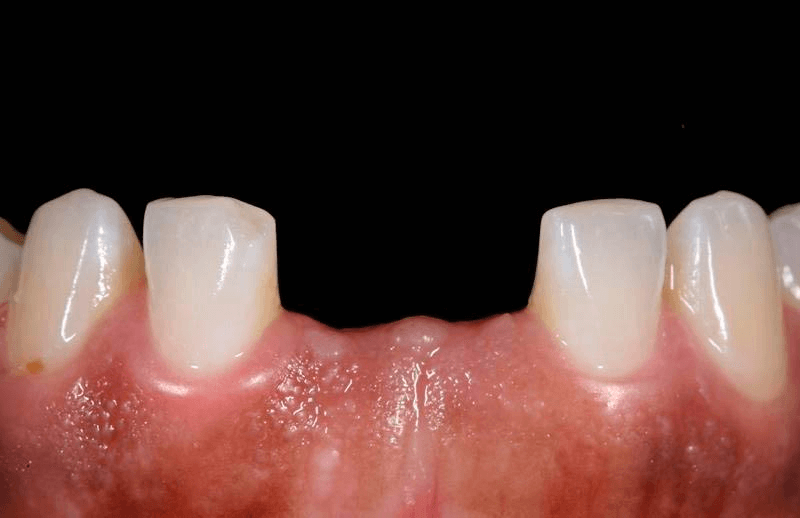 Доклад по теме Лечение ретенции зубов и сопутствующей патологии