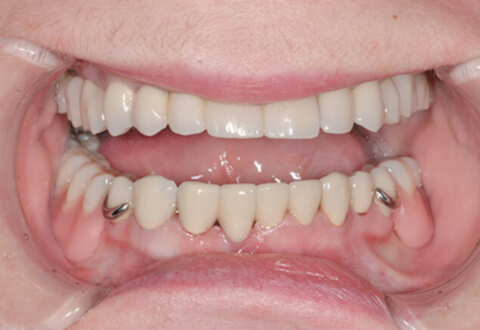 Бюгельный зубной протез