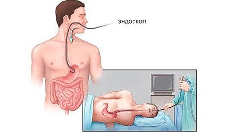 Гастроскопия «во сне»