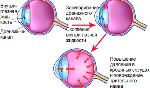 Глаукома, причины развития