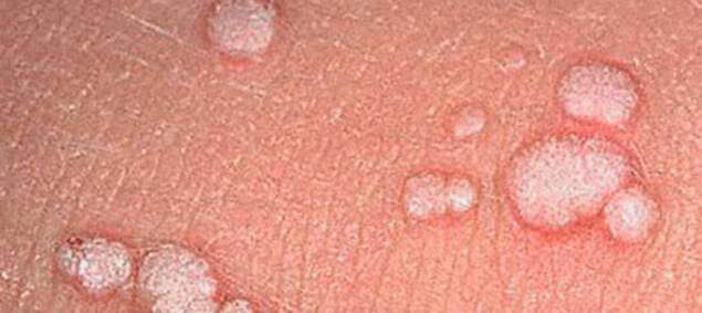 Фото остроконечные кондиломы на половых губах