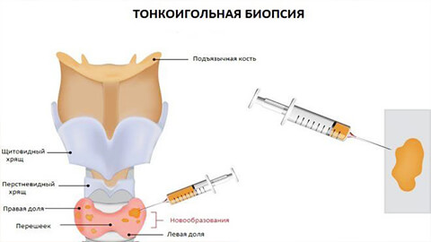 как делают биопсию щитовидной железы