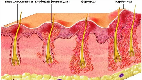 карбункул