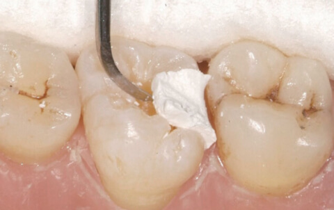 Зачем стоматолог ставит временную пломбу?