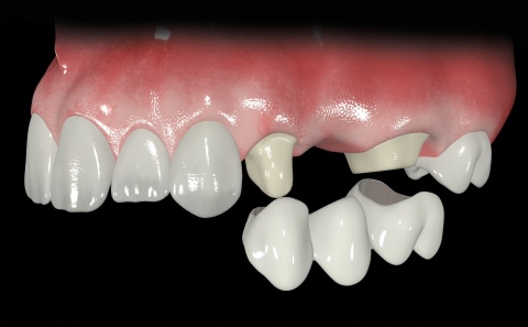 протезировании зубов
