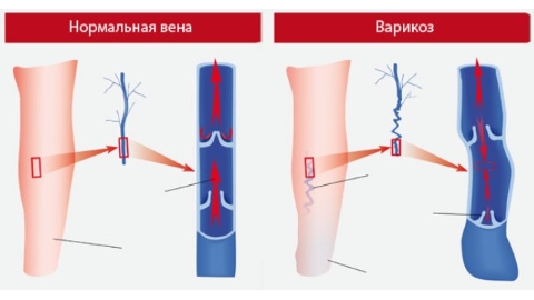 варикоз
