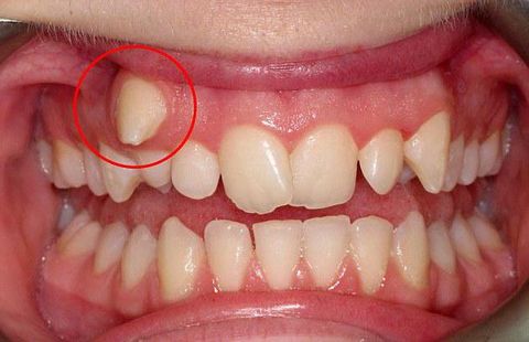 232 зуба и гипердонтия