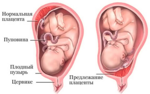 Гипоплазия плаценты у будущей мамы