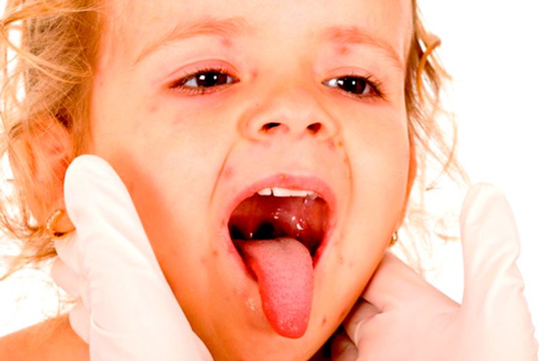 Лечение гнойных ангин у детей
