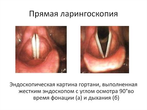 Ларингит на фоне гэрб