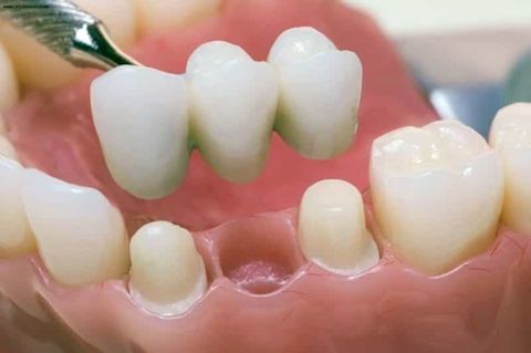 Несъемные зубные протезы 