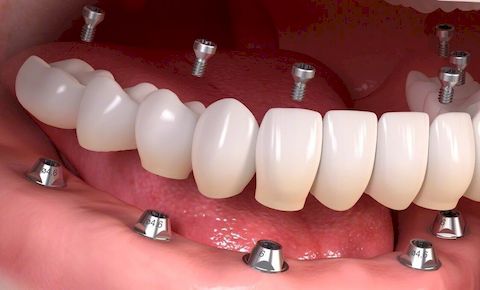 Несъемные зубные протезы 