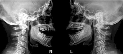 Рентген суставов челюсти 
