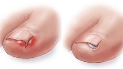 Лечение вросшего ногтя лазером