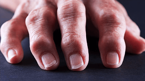 Массаж кистей рук, Лечение при артрите