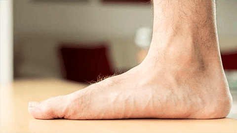 Массаж ног, Лечение плоскостопия