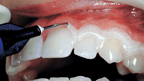 Отбеливание зубов гелем