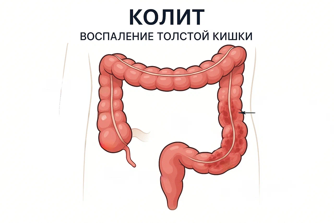 Из-за чего возникает колит кишечника Из-за чего возникает колит кишечника