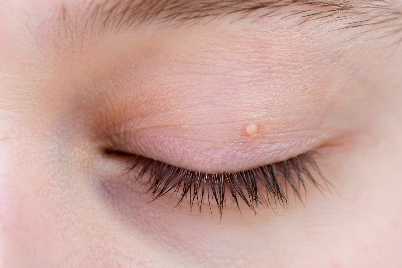 papilloma