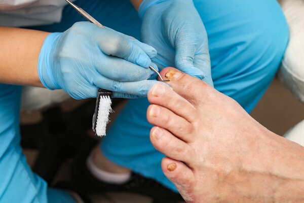 Проведение процедуры удаления ногтя
