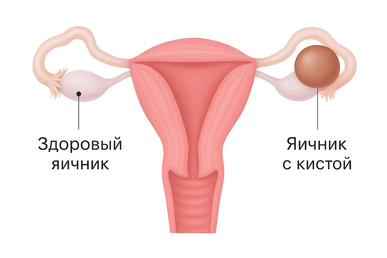 Виды кист яичников Виды кист яичников