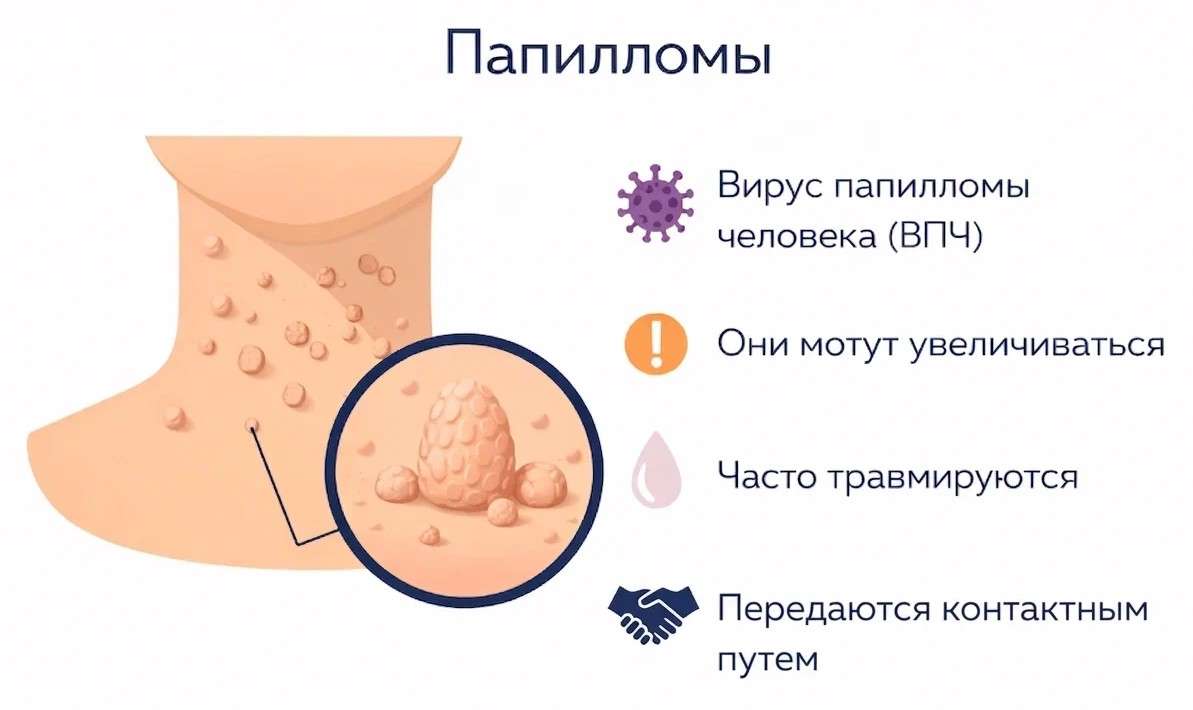 prichiny papillom