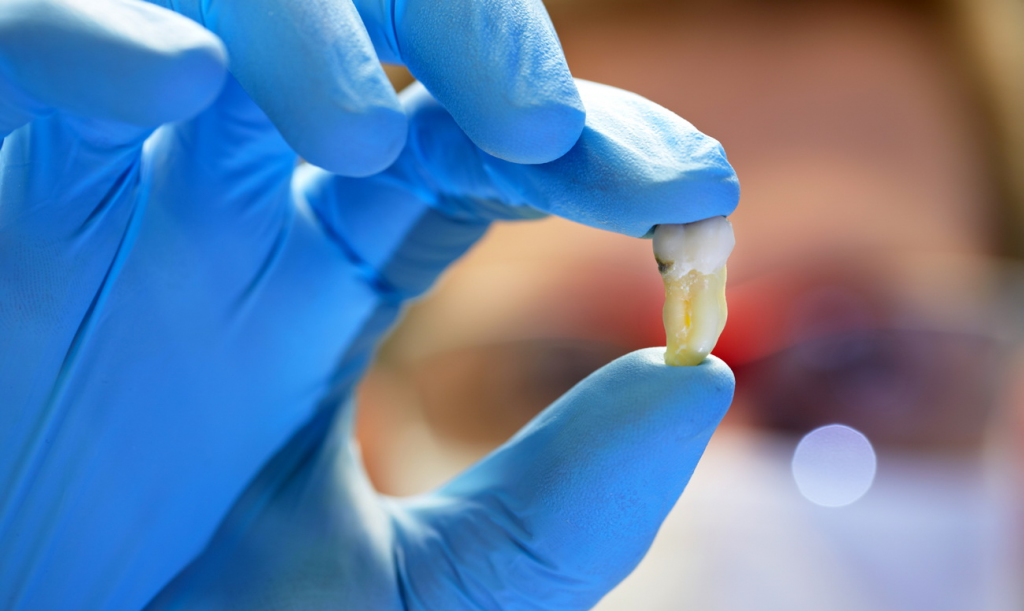 Реплантация зуба замена
