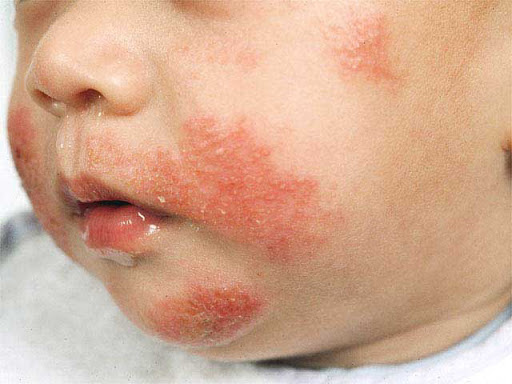 Пеленочный дерматит (опрелости) у детей