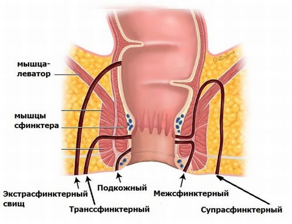 issechenie-svishchej1 issechenie-svishchej1