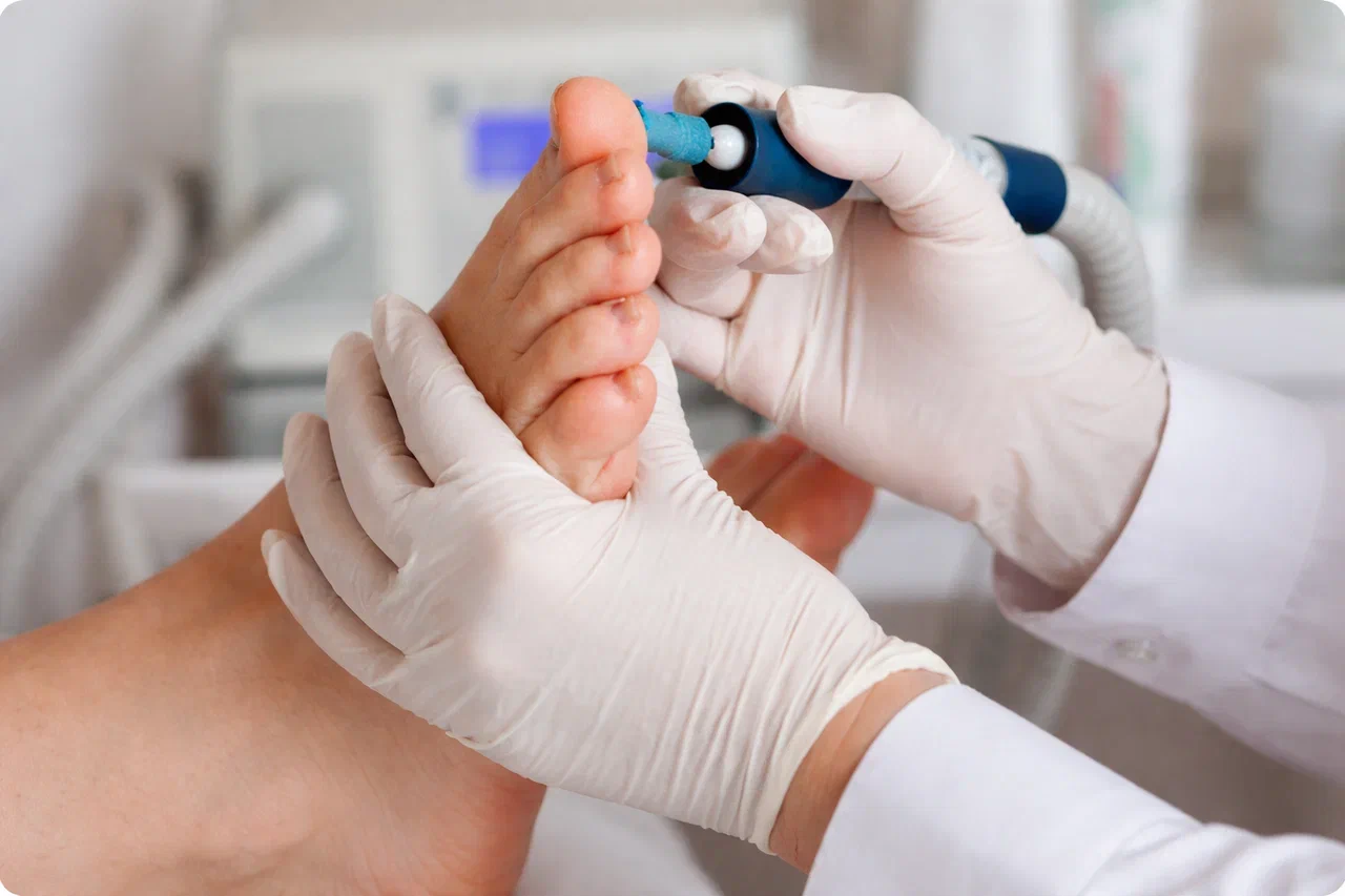 lechenie gribka nogtej