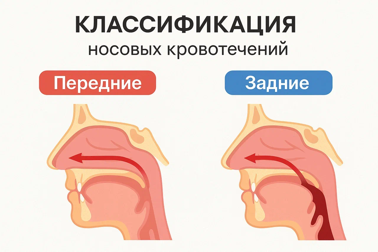 Классификация носовых кровотечений
