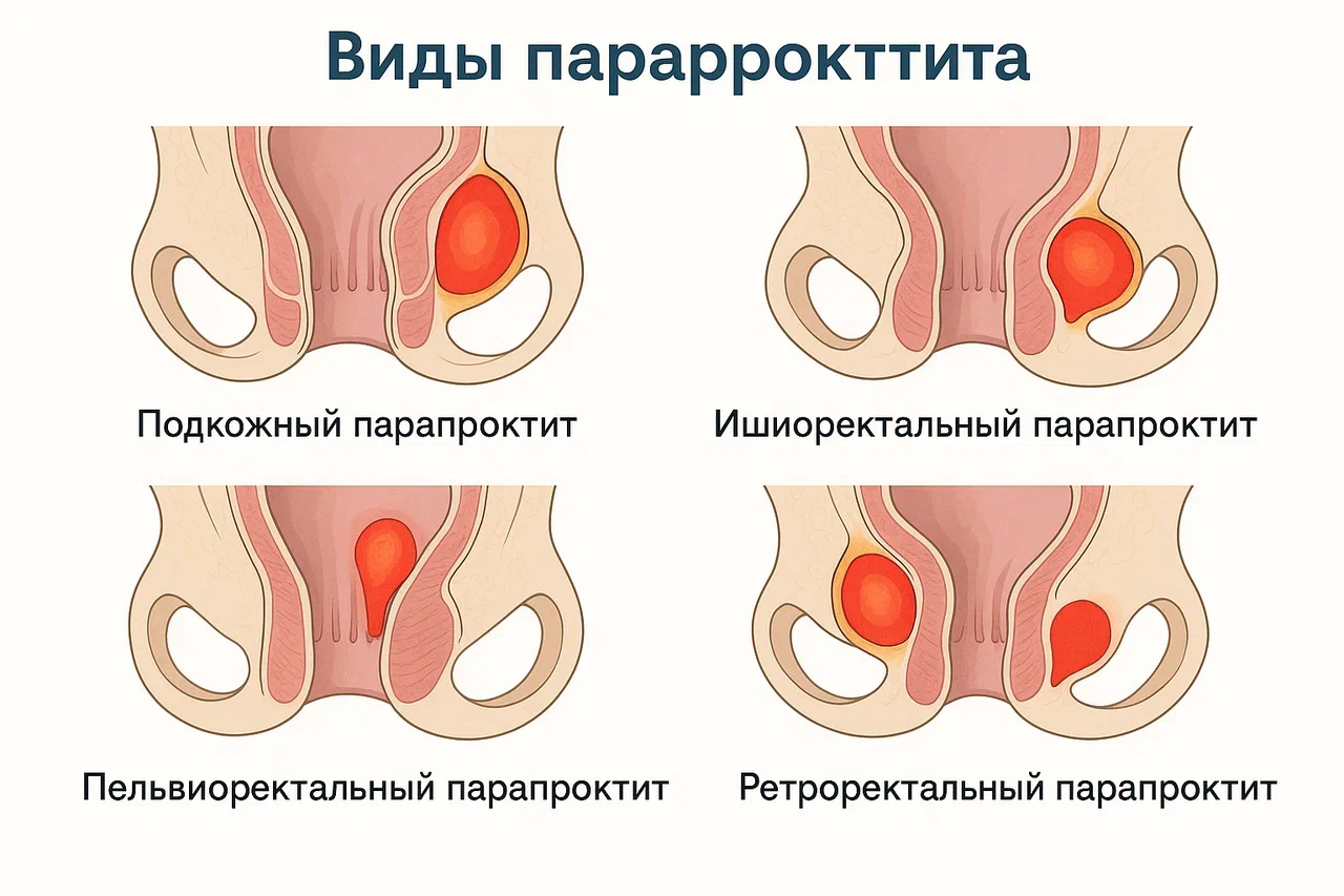 Виды парапроктита Виды парапроктита