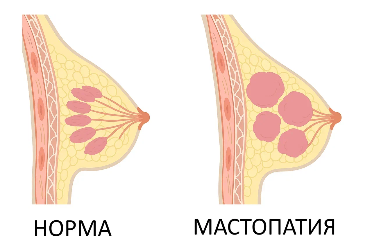 Мастопатия