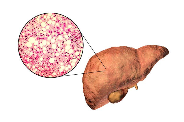 Виды жирового гепатоза