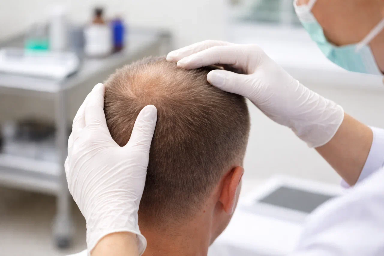 diagnostika alopecii