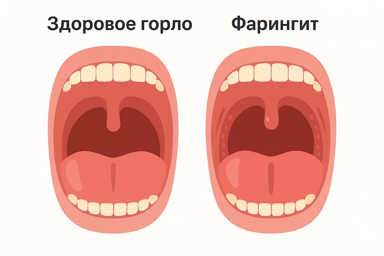 Виды хронического фарингита Виды хронического фарингита