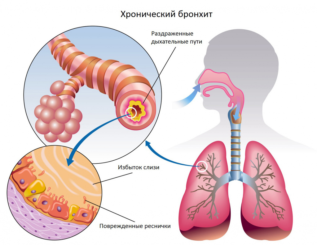 hronicheskij-bronhit1