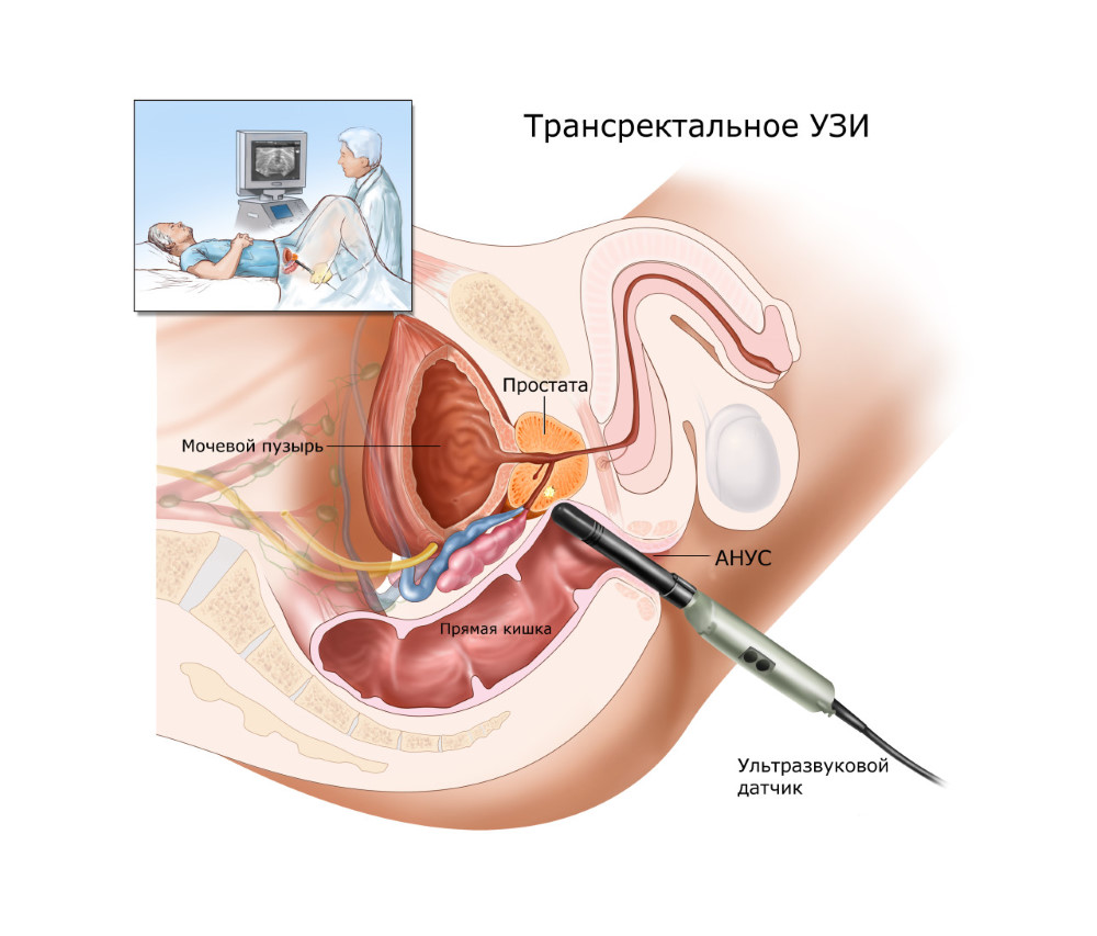 Проведение трансабдоминального УЗИ предстательной железы 