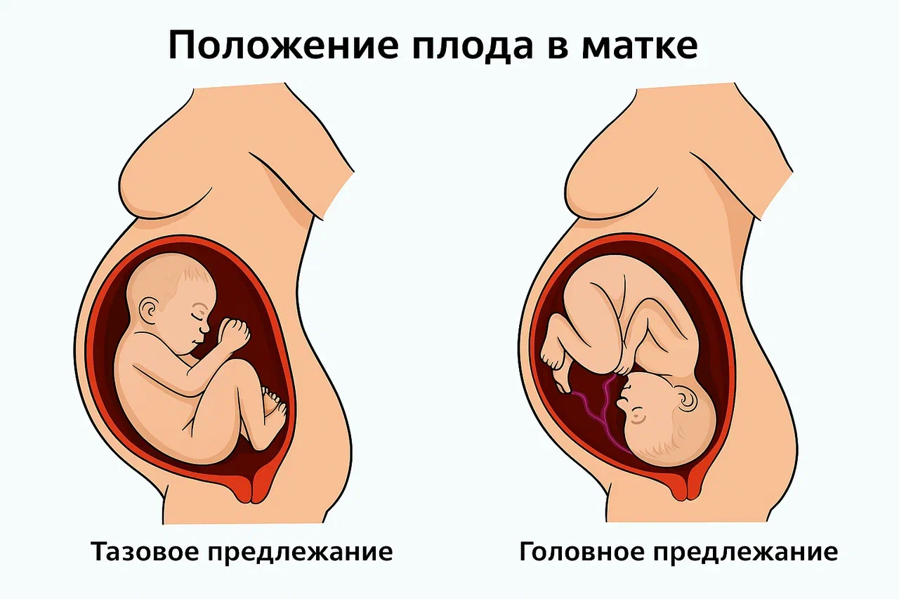 Виды тазового предлежания плода Виды тазового предлежания плода