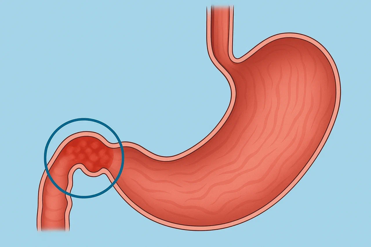 Виды дуоденита